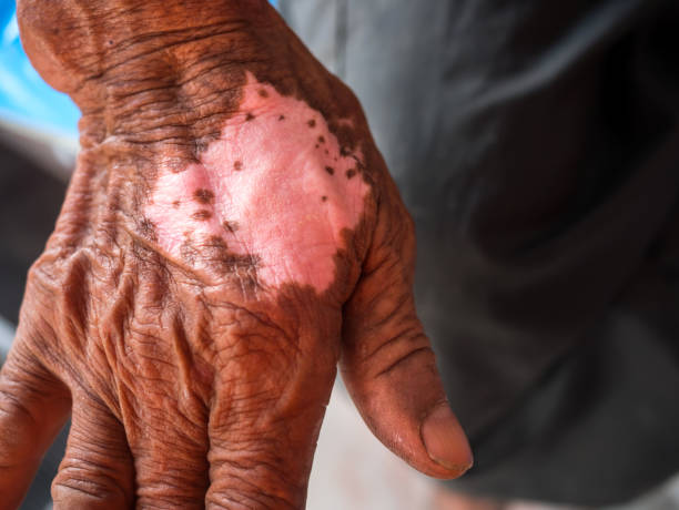 jamaican leprosy law